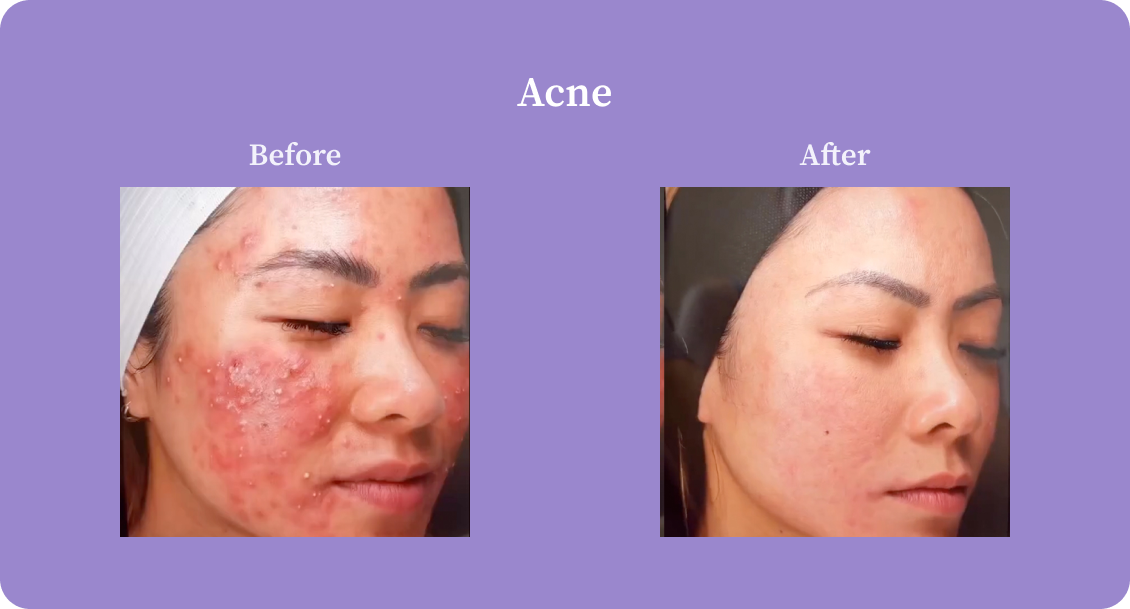 Acne-B:A