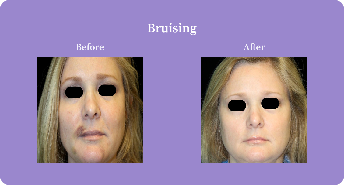 Bruising-B:A