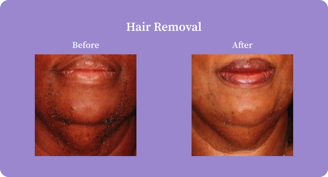 HairRemoval-B:A