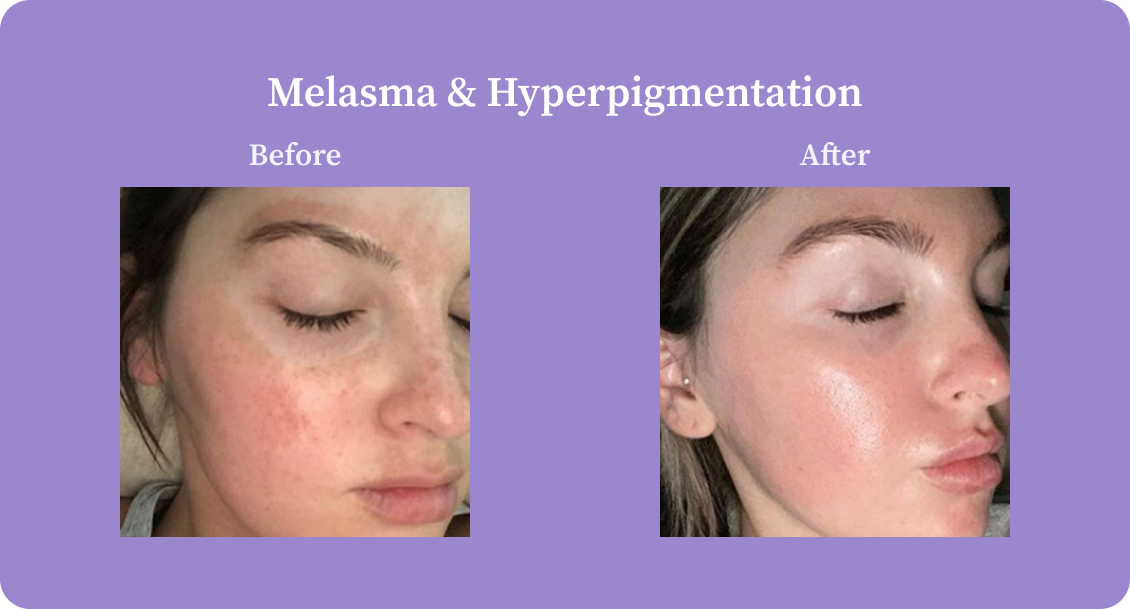 MelasmaHyperpigmentation-B:A