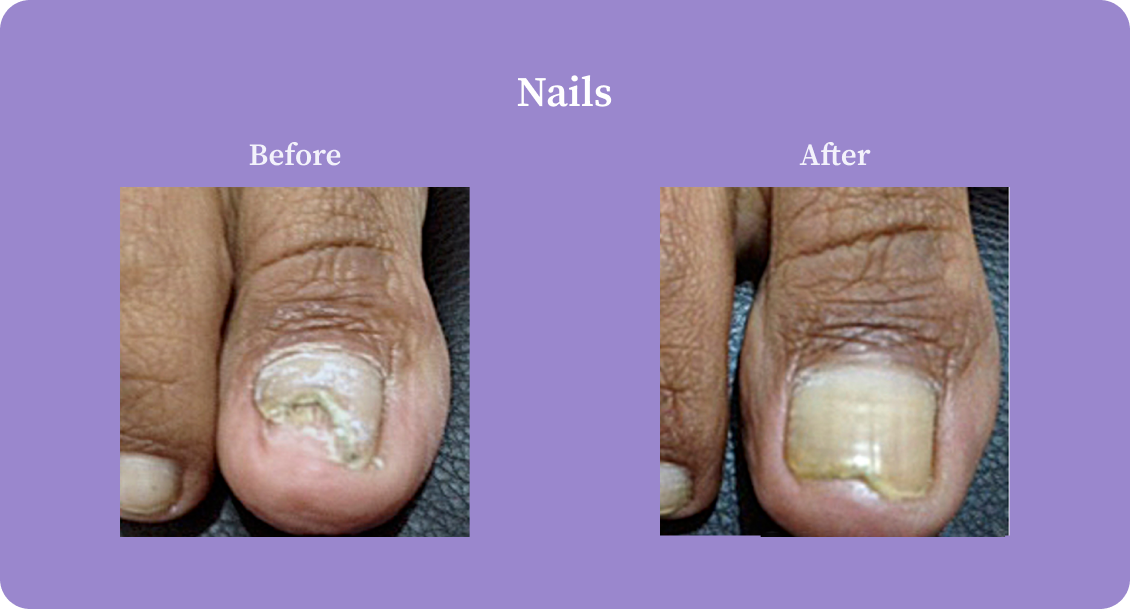 Nail-B:A