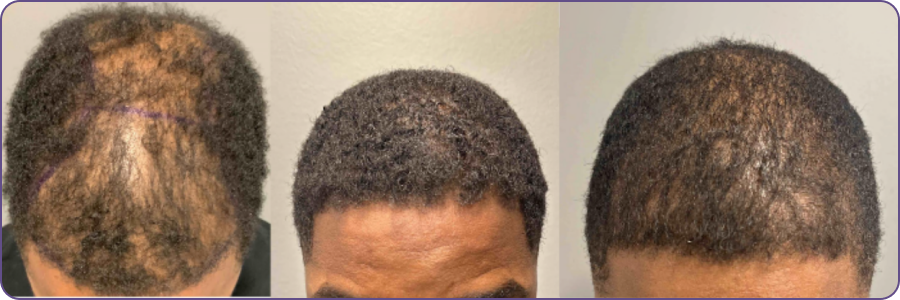 hairTransplantation