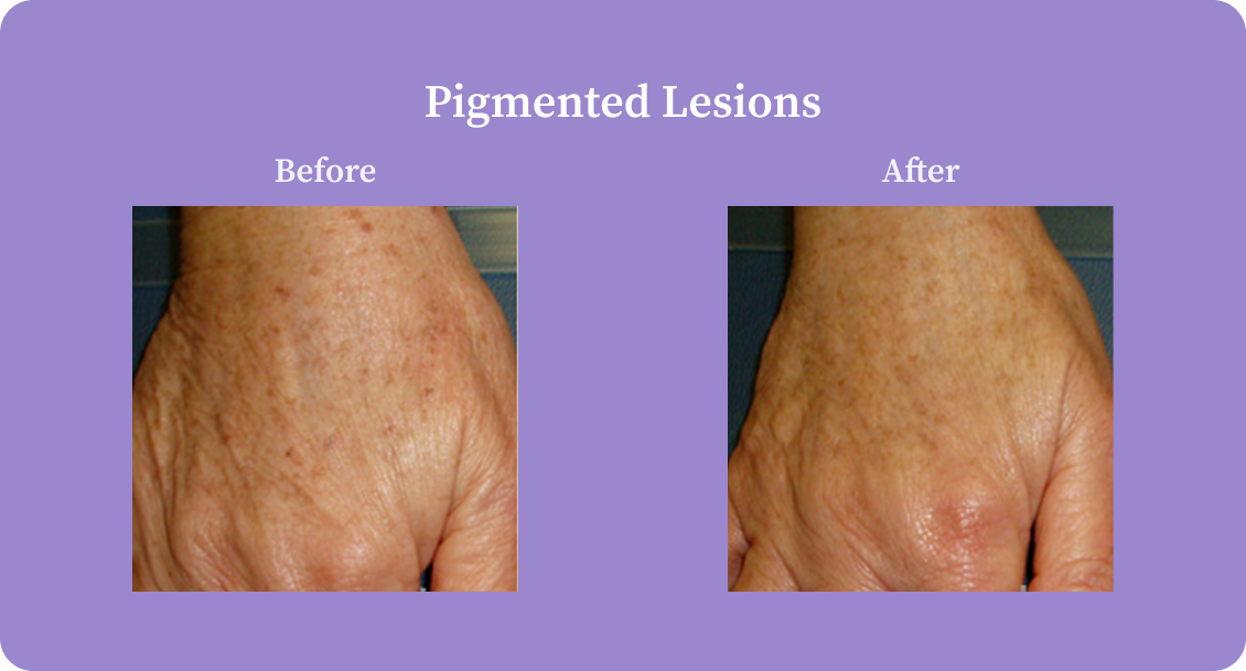 pigmentedLesions-B:A