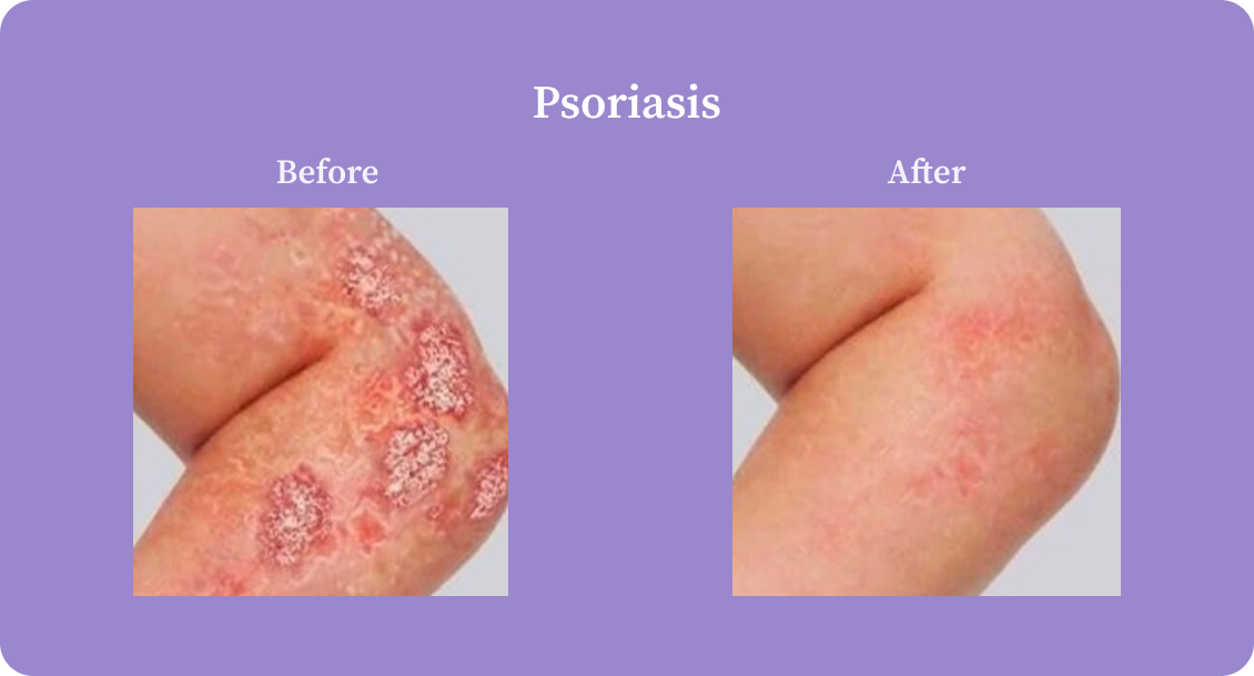 psoriasis-B:A