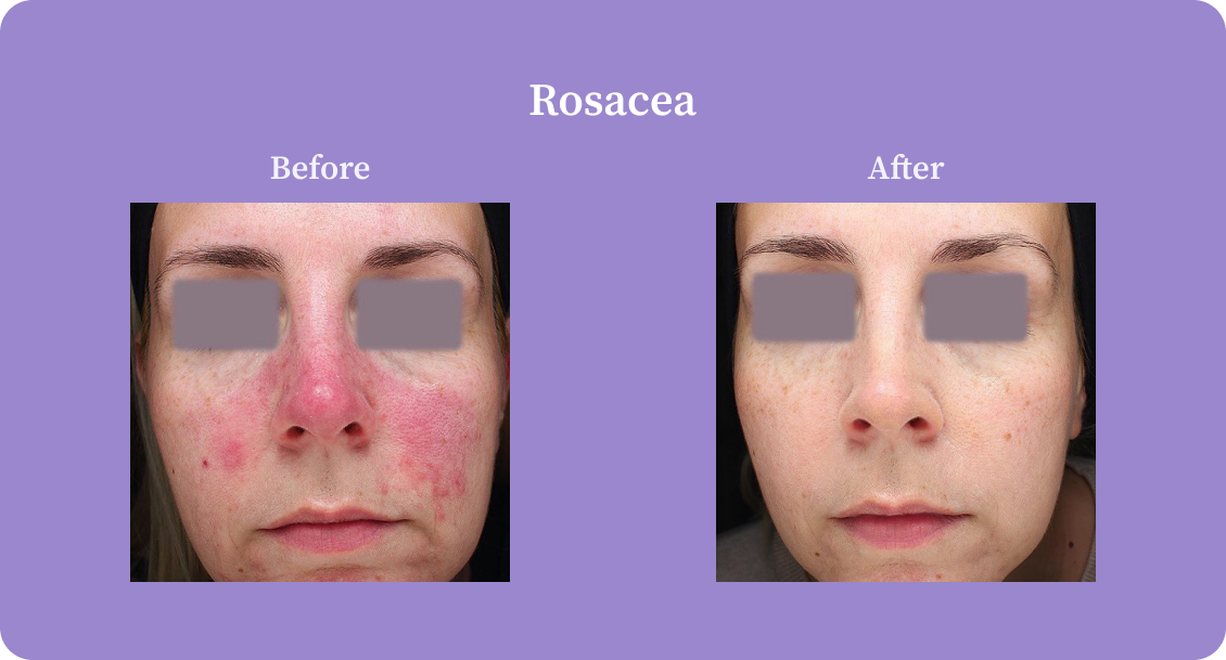 rosacea-B:A