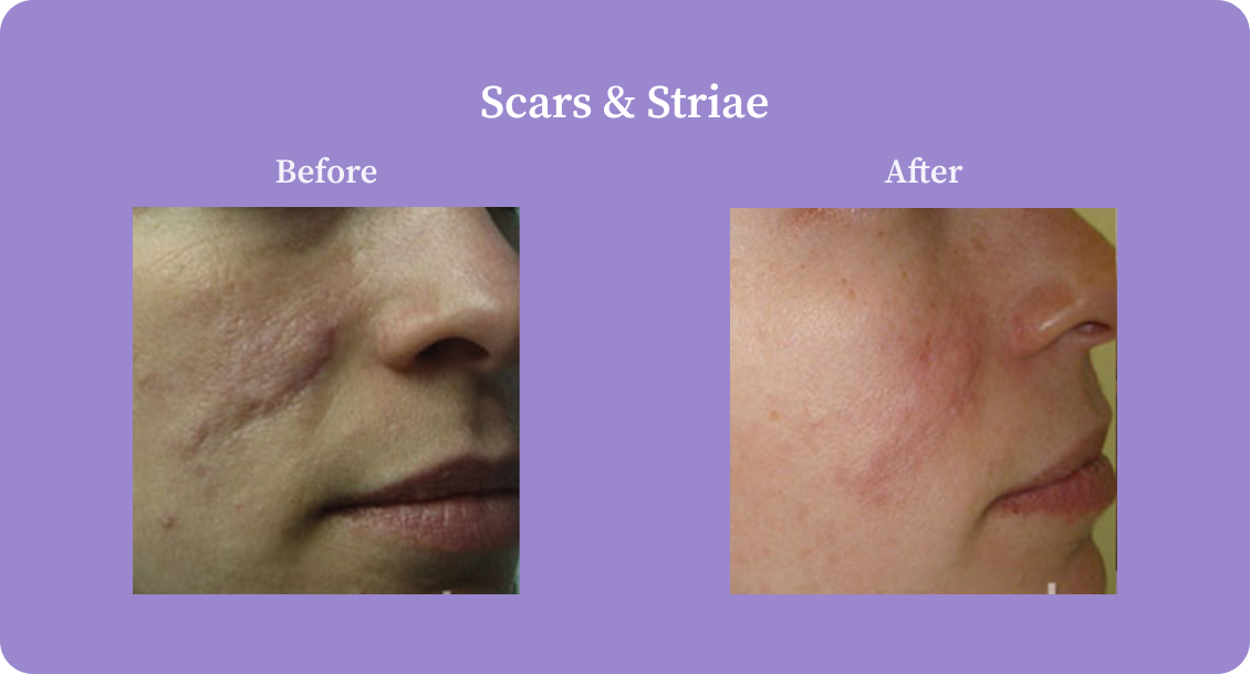 scarsStriae-B:A