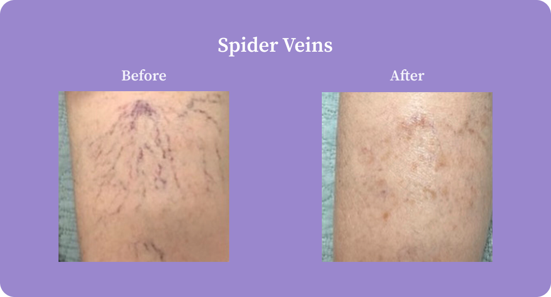 spiderVeins-B:A