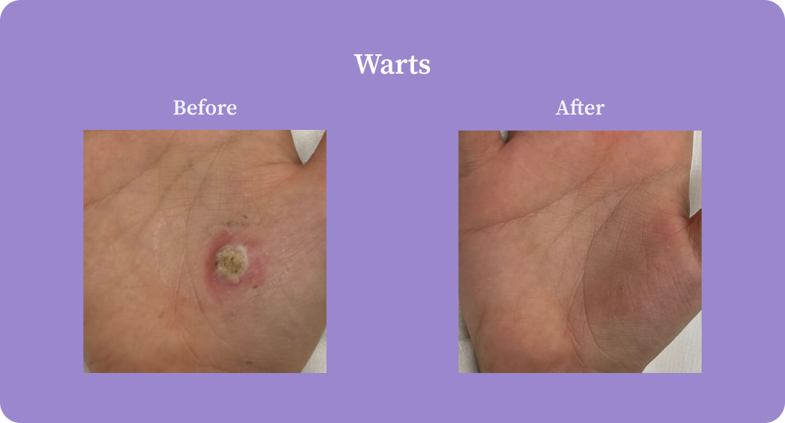 warts-B:A
