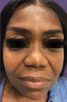 FillerTreatment Before