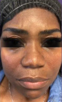 Filler Treatment After